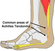 Achilles Tendionitis