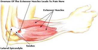 tennis-elbow-picture