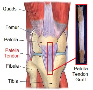 patellar-tendon-graft